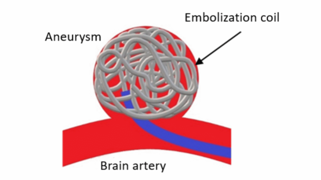 Embolization coil (Image Courtesy: Business Wire)